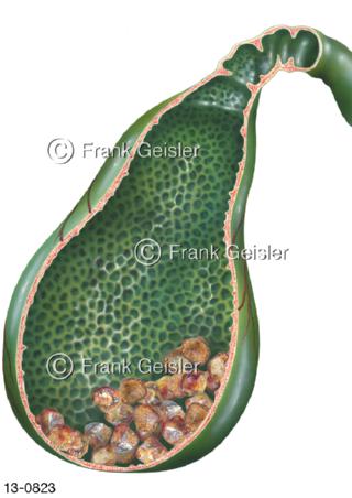 Gallenblase mit Gallensteine Cholelithen Gallenkonkrement