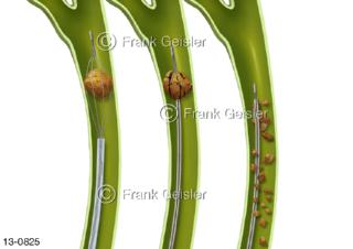 Gallengang Gallenweg Galle, Lithotripsie, Zertrümmerung von Gallensteinen