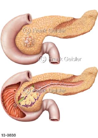 Pankreas mit Pankreaskarzinom