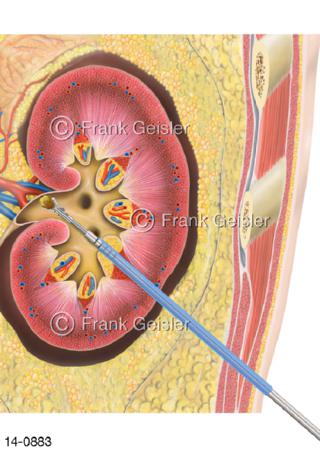 Nierenbecken mit Steinextraktion