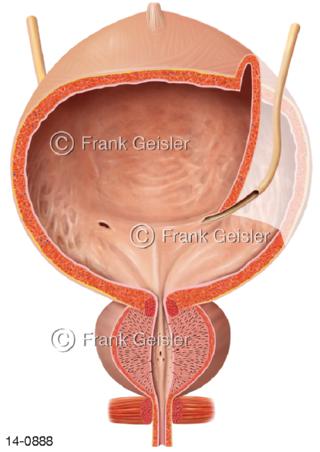 Harnleiter Mann, Harnröhre Ureter Harnblase