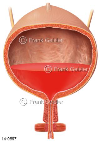 Harnblase, Hämaturie, Blut in Urin