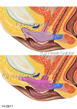Genitalien Frau, Klitoris Kitzler erregt