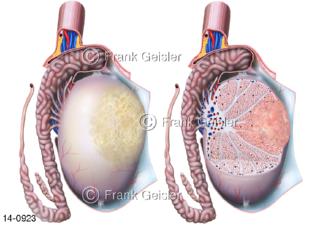 Ansichten Hoden mit Nebenhoden Epididymis, Hodenläppchen mit Hodenkrebs Hodentumor