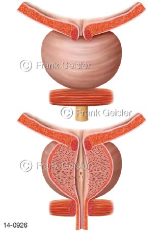 Ansichten Prostata Vorsteherdrüse mit Frontalschnitt