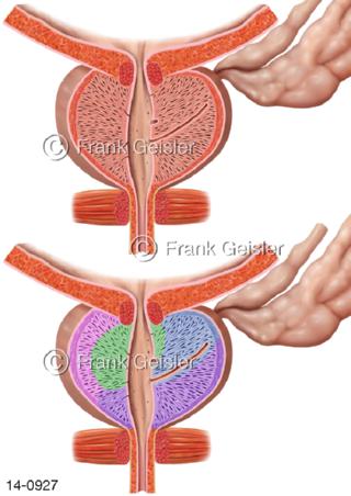Prostata Vorsteherdrüse, Sagittalschnitt Zonenbildung