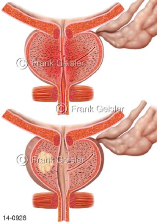Sagittalschnitt Prostata, Prostatitis Prostatakrebs