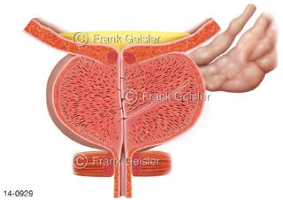 Prostata Vorsteherdrüse, Sagittalaschnitt Prostatavergrößerung Hyperplasie