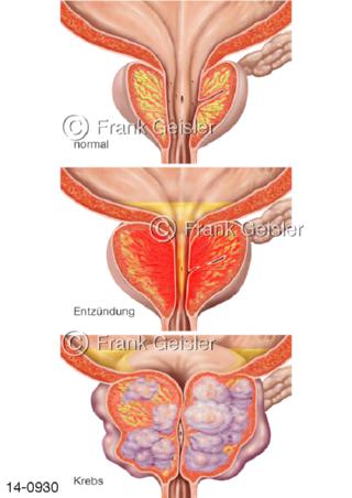 Prostata mit Prostatitis Prostatakrebs