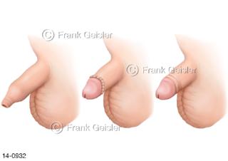 Penis mit Phimose Vorhautverengung, Beschneidung Zirkumzision OP der Vorhaut