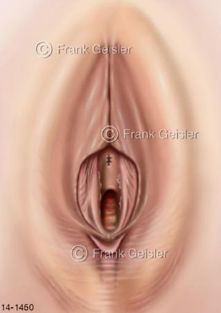 Genitalien FGM FGC, Schamlippen Exzision