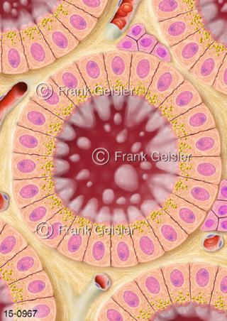 Zellen Gewebe Schilddrüse, Überfunktion