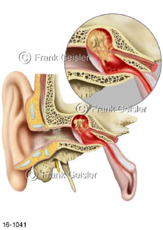 Bildung Ohrenschmalz, Mittelohrentzündung Mittelohrvereiterung
