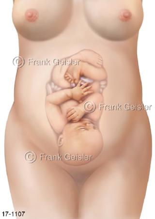 Lage Fetus Fötus im Bauch Mutter