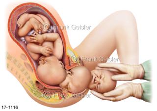 Geburtskanal Gebärmutterhals, Vagina, Beckenboden Baby bei Entbindung