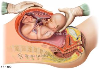 Operative Entbindung, Schnittentbindung Kaiserschnitt Sectio caesarea
