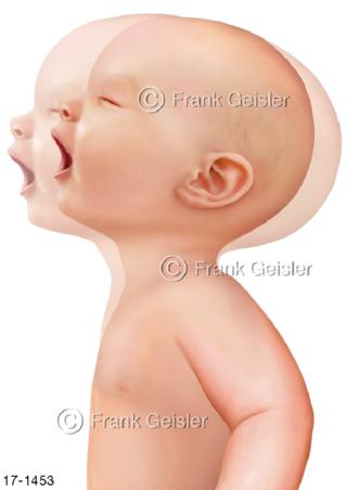 Notfall Schütteltrauma Schütteln Baby