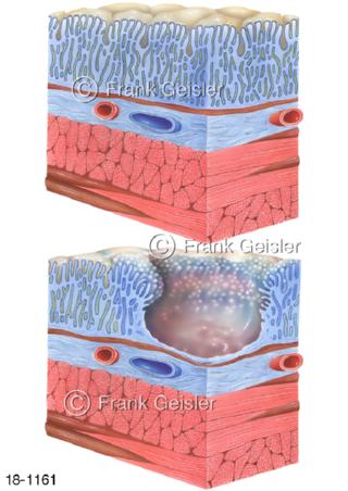 Erkrankung Magen, Magenschleimhaut mit Ulkus