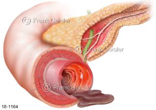 Erkrankung Bauchspeicheldrüse, Insuffizienz der Drüsen, Pankreasinsuffizienz
