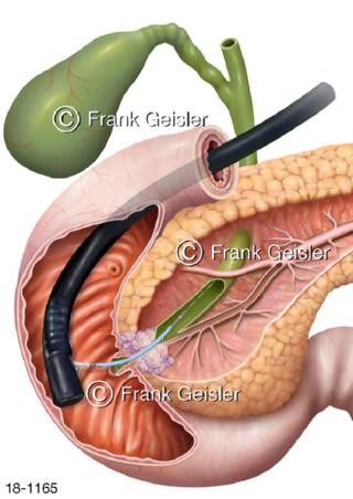 Stenose Pusher-Stent bei Pankreaskarzinom Bauchspeicheldrüsenkrebs