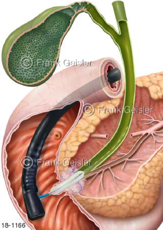 Multi-Stage-Ballon bei Pankreaskarzinom Bauchspeicheldrüsenkrebs