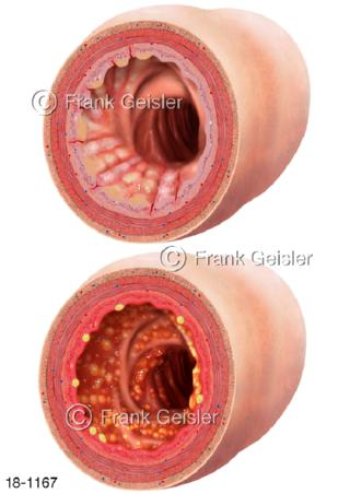 Darmerkrankungen Morbus-Crohn und Colitis ulcerosa