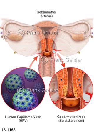 HP-Viren und Gebärmutterhalskrebs