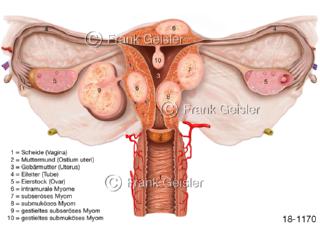 Erkrankung Uterus Gebärmutter mit Uterus myomatosus Myome