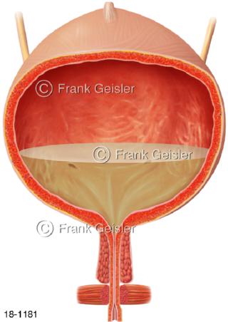 Zystitis Harnblase, Blasenentzündung