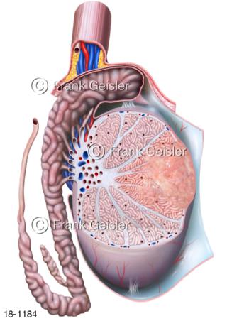 Hoden mit Hodenkrebs Keimzellentumor Hodenkarzinom