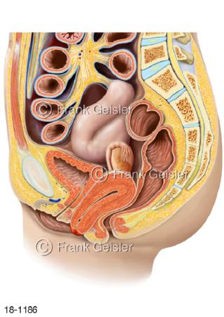 Totalprolaps Uterus, Gebärmuttervorfall Scheide