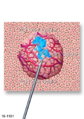 Tumorbehandlung Ethanol-Ablation bei Krebs