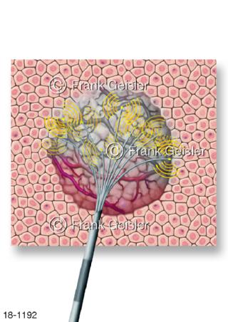 Tumorbehandlung, Mikrowellenablation bei Krebs