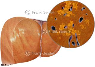 Erkrankung Leber, Fettleber Steatosis hepatis durch in Leberzellen eingelagertes Fett