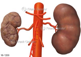 Erkrankung Niere, Schrumpfniere Nephrozirrhose Endstadium chronischer Nierenerkrankungen