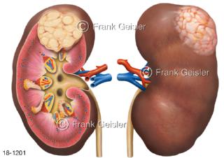 Erkrankung Nieren, Nierentumor Nierenkrebs Nierenzellkarzinom bösartiger Tumor