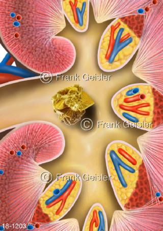 Erkrankung Niere, Nierenstein Harnstein in Nierenkelch