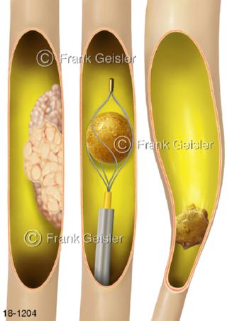Harnleiter Ureter Uretertumor Harnleiterstein Ureterorenoskopie URS Urinstau