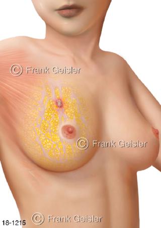 Brustdrüse Mamma, Brustkrebs Brust Frau