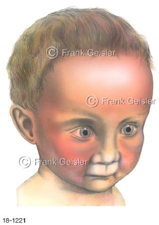 Kinderkrankheit Scharlach Scarlatina