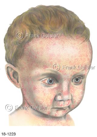 Kinderkrankheit Masern Morbilli Hautflecken