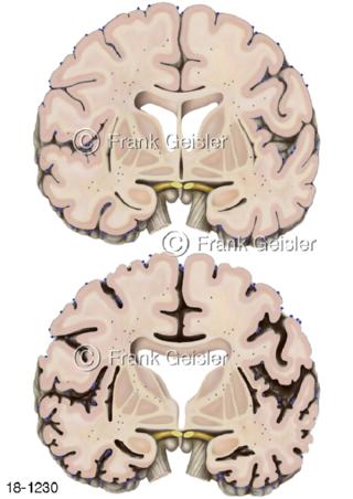 Hirnschnitt Alzheimer-Krankheit Demenz