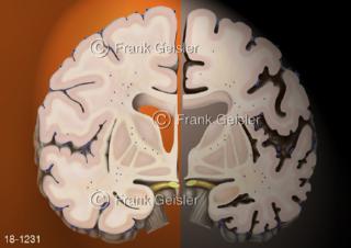 Frontalschnitt gesundes Gehirn und Alzheimer-Krankheit Morbus Alzheimer Demenz