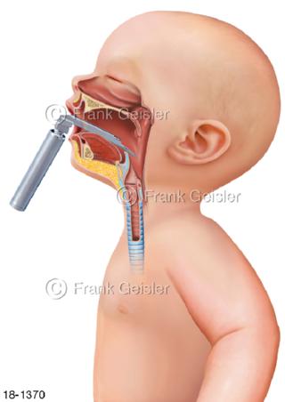 Notfall Platzierung Laryngoskop Kleinkind Baby