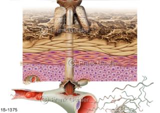 Notfall Borreliose-Infektion durch Zeckenbiss Borrelien Borrelia burgdorferi