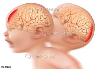 Notfall Baby Kleinkind mit Schütteltrauma, Subduralhämatome Gehirn frontal dorsal