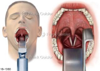 Notfall Laryngoskopie, Kehlkopfspigelung Larynx Kehlkopf