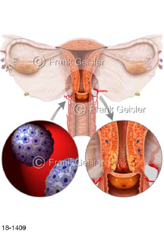 Zervixkarzinom Gebärmutterhalskrebs