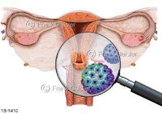 Zervixkarzinom Gebärmutterhalskrebs mit Humane Papillomaviren