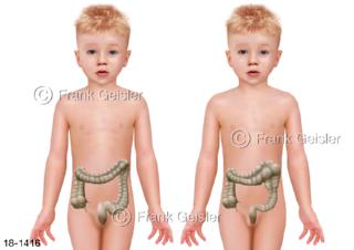 Kind mit Megacolon Morbus Hirschsprung, eine Fehlbildung im Dickdarm